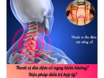 Thoát vị đĩa đệm cổ  nguy hiểm không? Biện pháp điều trị hợp lý?