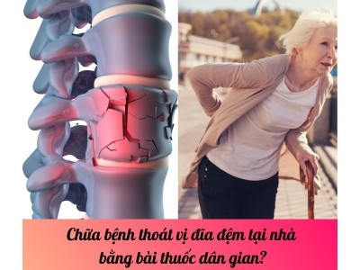 Chữa bệnh thoát vị đĩa đệm tại nhà bằng bài thuốc dân gian?