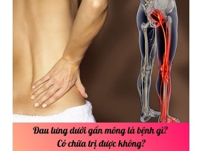 Đau lưng dưới gần mông là bệnh gì? Có chữa trị được không?